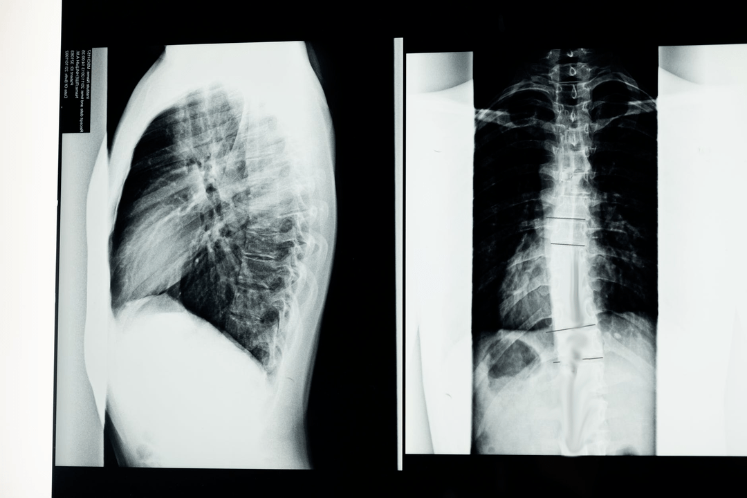 mugurkaula kakla daļas osteohondroze attēlā