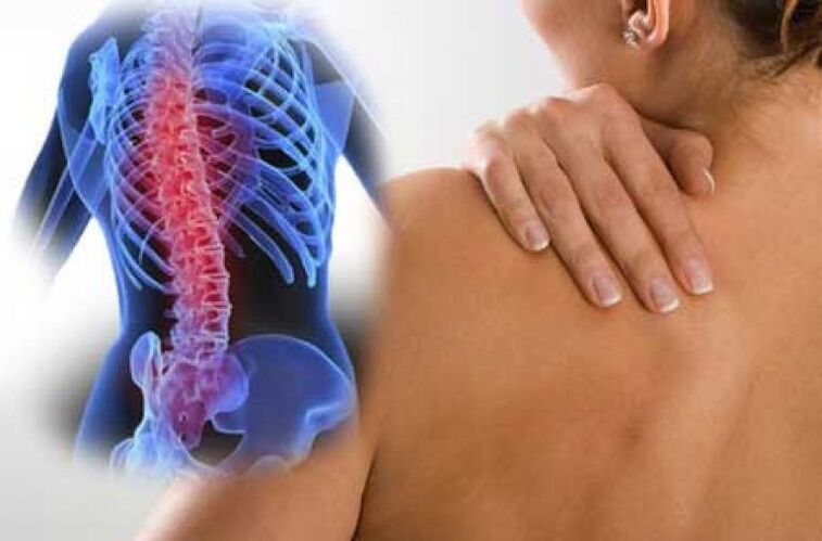 Ar osteohondrozi sāpes var izstarot uz attālām ķermeņa daļām