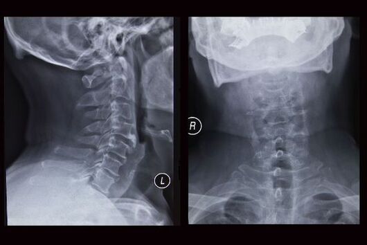 Kakla mugurkaula rentgena attēls (pacientei ir osteohondroze)