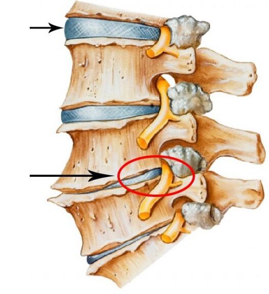 dzemdes kakla osteohondroze
