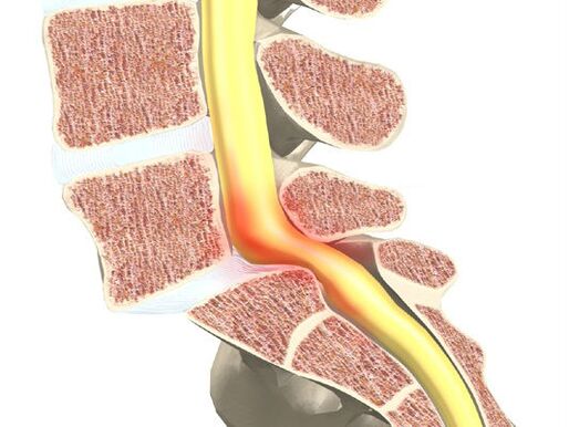 Asins-motora segments osteohondrozei
