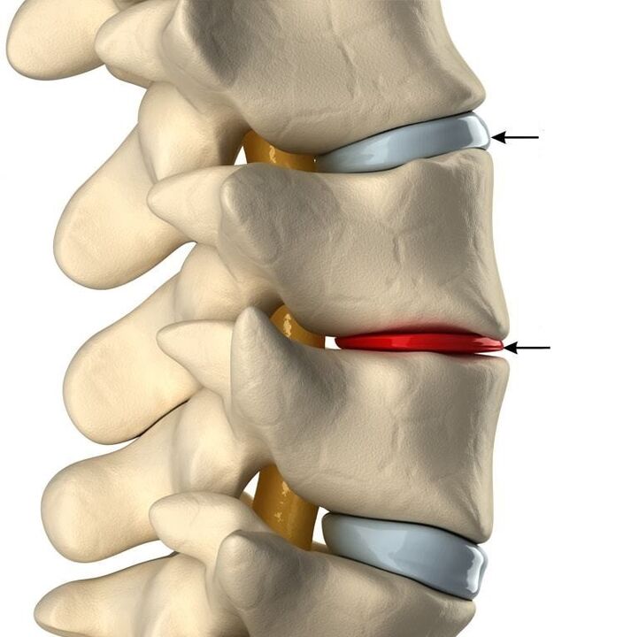 Atšķirība starp veselīgu disku un disku ar osteohondrozi