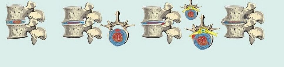 Dažādi krūšu osteohondrozes posmi