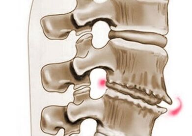 skriemeļu bojājumi krūšu kurvja osteohondrozē