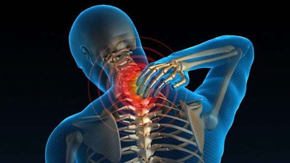Sāpes, pagriežot kaklu, var liecināt par mugurkaula kakla osteohondrozes sindromu